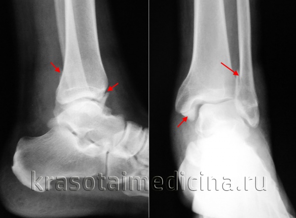 Рентгенография голеностопного сустава. Переломы обеих лодыжек со смещением отломков.