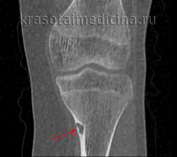 КТ коленного сустава. Остеоид-остеома большеберцовой кости.
