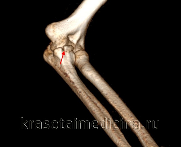 КТ (3D-реконструкция) локтевого сустава. Перелом венечного отростка локтевой кости.
