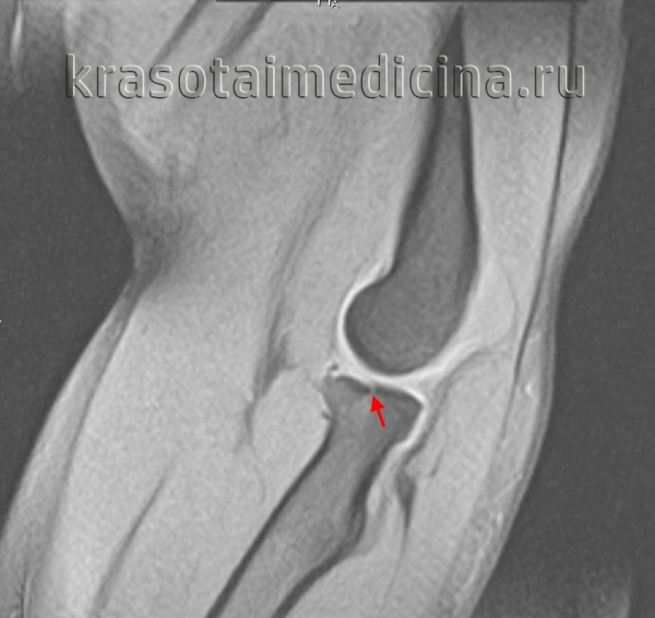 МРТ локтевого сустава. Перелом головки лучевой кости с незначительным смещением отломков.