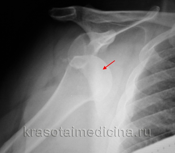 Рентгенография плечевого сустава. Вывих головки правой плечевой кости из суставной ямки.