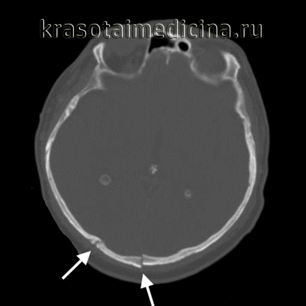 На аксиальной КТ в костном окне определяется перелом затылочной кости со смещением отломков