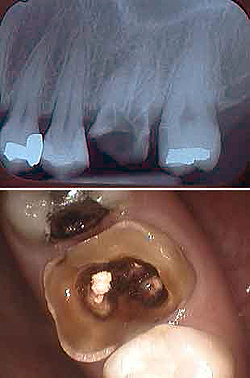 Перелом зуба рентгенограмма