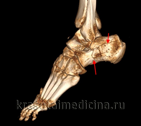 КТ стопы (3D реконструкция). Оскольчатый перелом пяточной кости с разнонаправленным смещением осколков.