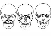 Перелом верхней челюсти