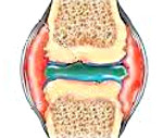 Хронический артрит