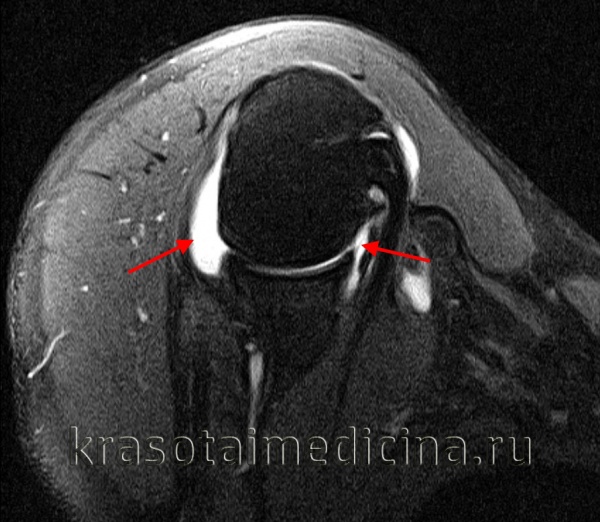 МРТ плечевого сустава (FS). Избыточное количество жидкости в полости сустава (экссудативный синовит)