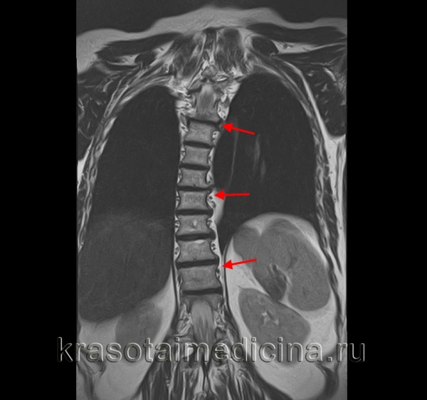 МРТ грудного отдела позвоночника. Выраженная дугообразная сколиотическая деформация грудного отдела позвоночника вправо.
