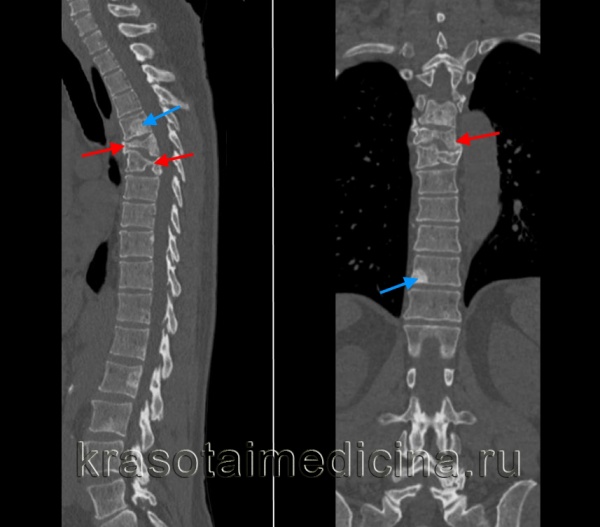 КТ ГОП. Патологический перелом 6 и 7 грудных позвонков (красная стрелка) на фоне вторичного поражения позвонков (синяя стрелка).