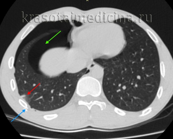 КТ ОГК. Контузионный очаг в нижней доле правого легкого (красная стрелка) у пациента с торакальной травмой: перелом ребра справа (синяя стрелка), пневмоторакс справа (зеленая стрелка).