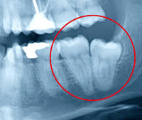 Анкилоз зуба