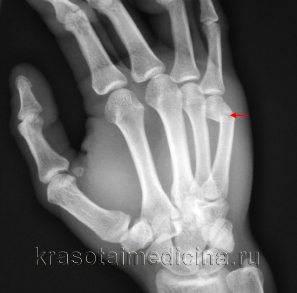 Рентгенография кисти. Перелом пятой пястной кости со смещением отломков под углом.