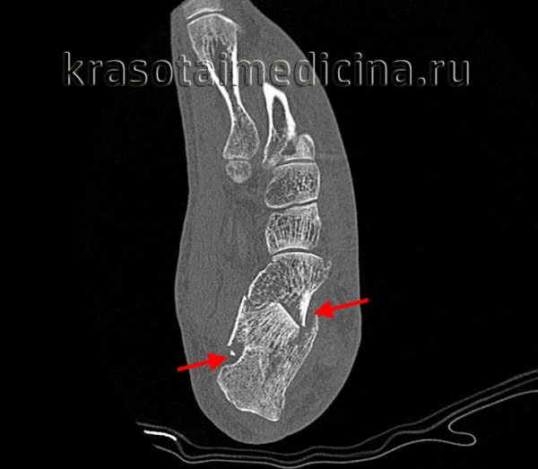 КТ стопы. Перелом пяточной кости (этот же пациент).