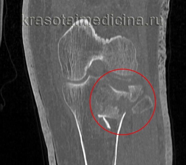 КТ коленного сустава. Оскольчатый перелом латерального мыщелка со смещением.