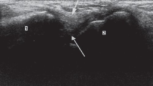 Поперечная сонограмма с визуализацией ладьевидно-полулунной связки, соединяющей ладьевидную и полулунную кости