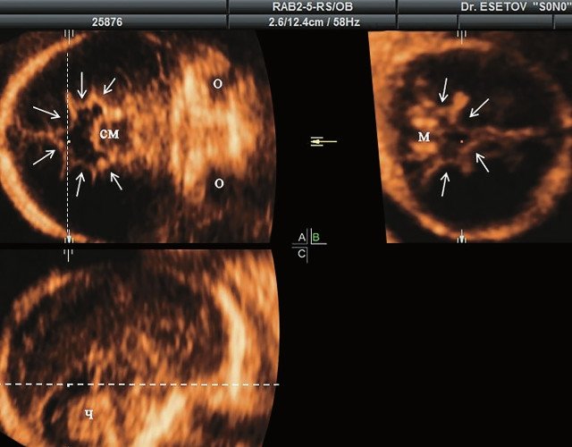 УЗИ мозга плода - трехмерная реконструкция (беременность 24,3 нед; СМ - средний мозг, О - орбита, Ч - червь, М - мозжечок)