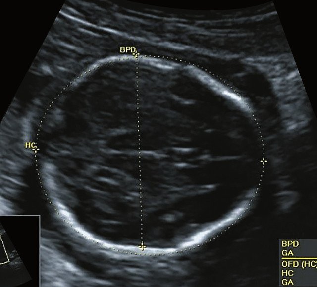 УЗИ плода - уплощенный затылок и выпуклые темпоральные бугры (беременность 20,3 нед)