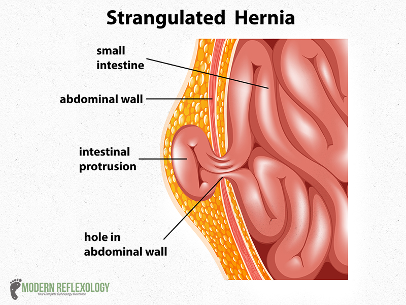 Strangulated Hernia