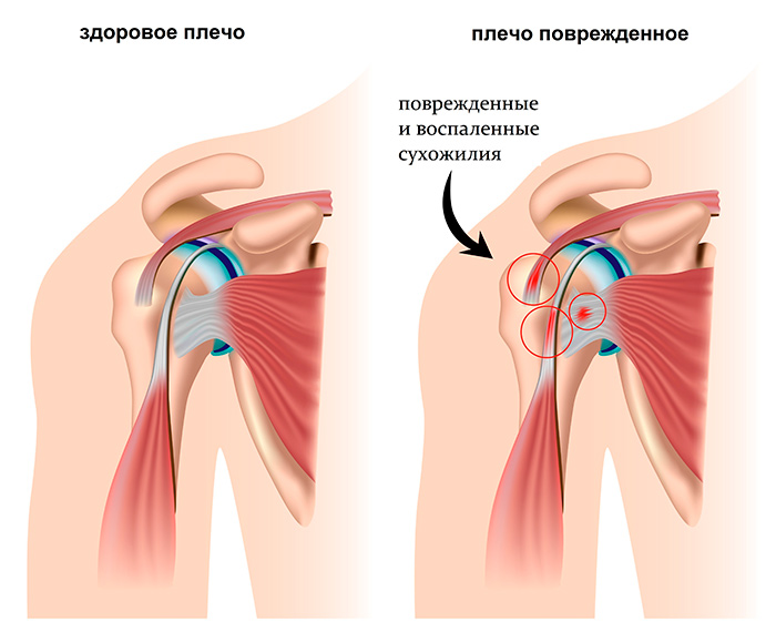 Образование тендинита сухожилия надостной мышцы плеча