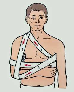Первая помощь при вывихе плечевого сустава