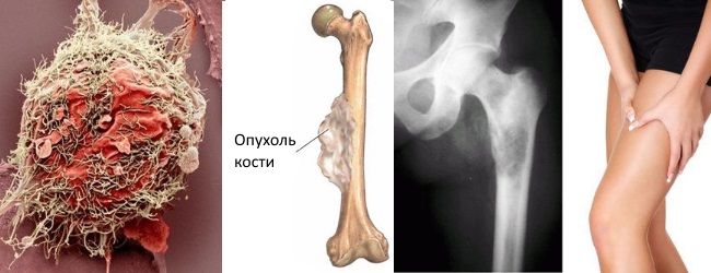 Опухоль кости злокачественная