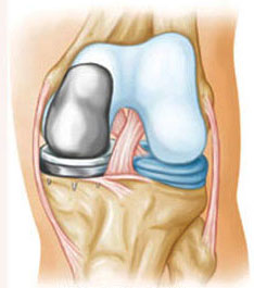 Одномыщелковый эндопротез коленного сустава
