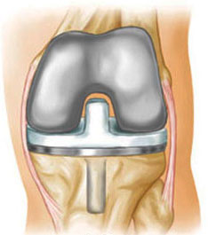 Тотальная замена коленного сустава - полный эндопротез