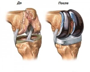 Замена коленного сустава - до и после операции