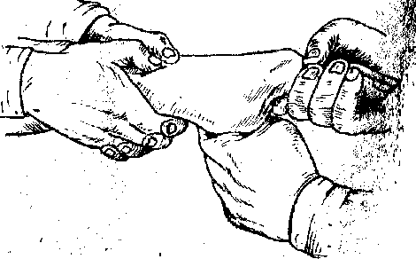 Закрытая репозиция при переломе руки