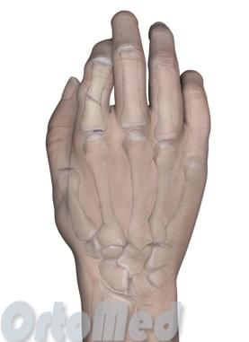 Перелом фаланги пальцев кисти: признаки, симптомы, лечение ...