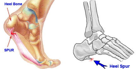 Heel Spur