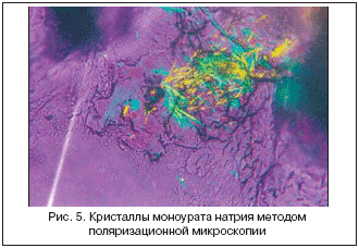 Рис. 5. Кристаллы моноурата натрия методом поляризационной микроскопии
