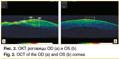Рис. 2. ОКТ роговицы OD (a) и OS (b) Fig. 2. OCT of the OD (a) and OS (b) cornea