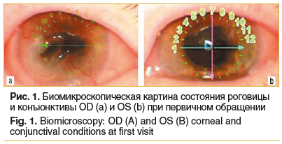 Рис. 1. Биомикроскопическая картина состояния роговицы и конъюнктивы OD (a) и OS (b) при первичном обращении Fig. 1. Biomicroscopy: OD (A) and OS (B) corneal and conjunctival conditions at first visit