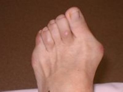 шишки на пальцах ног 