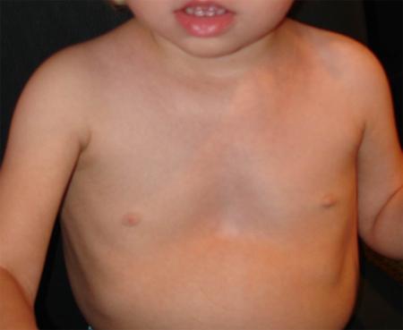 дефорация грудной клетки у детей
