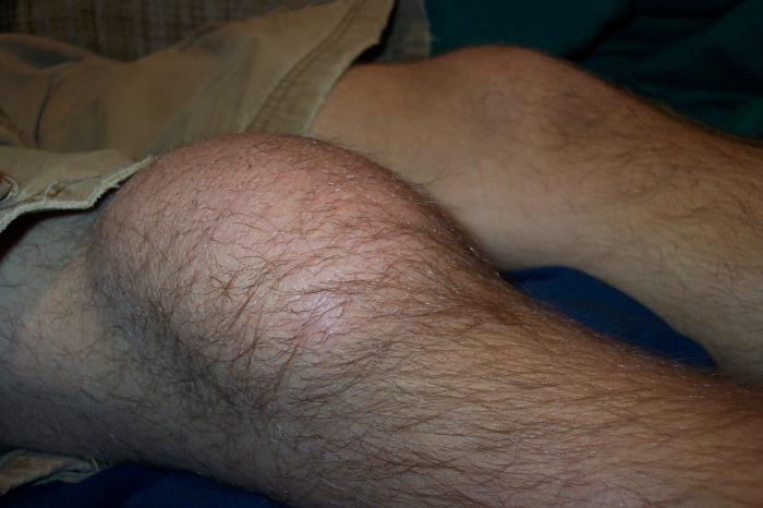бурсит коленного сустава симптомы лечение