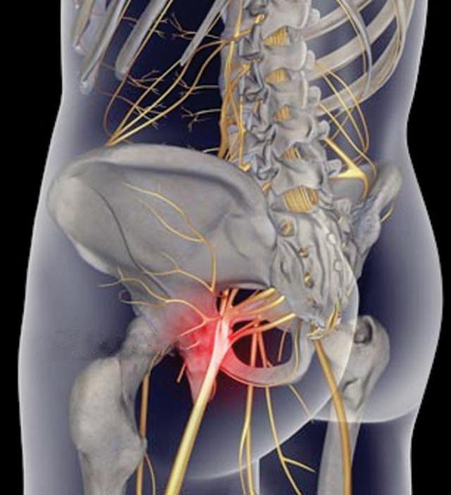 лечение ишиаса седалищного нерва 