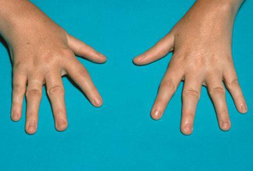 ревматоидный артрит пальцев рук 