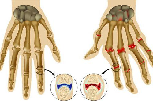 ревматоидный артрит пальцев рук первые симптомы лечение