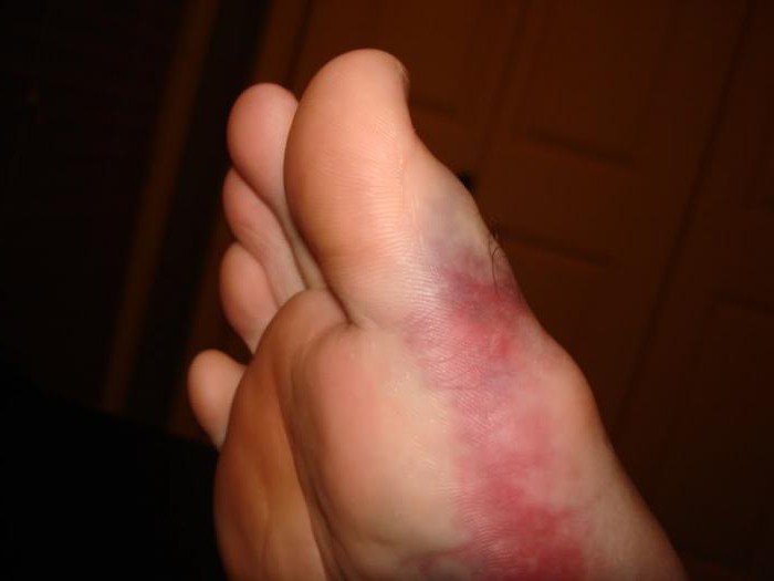 перелом большого пальца ноги лечение 