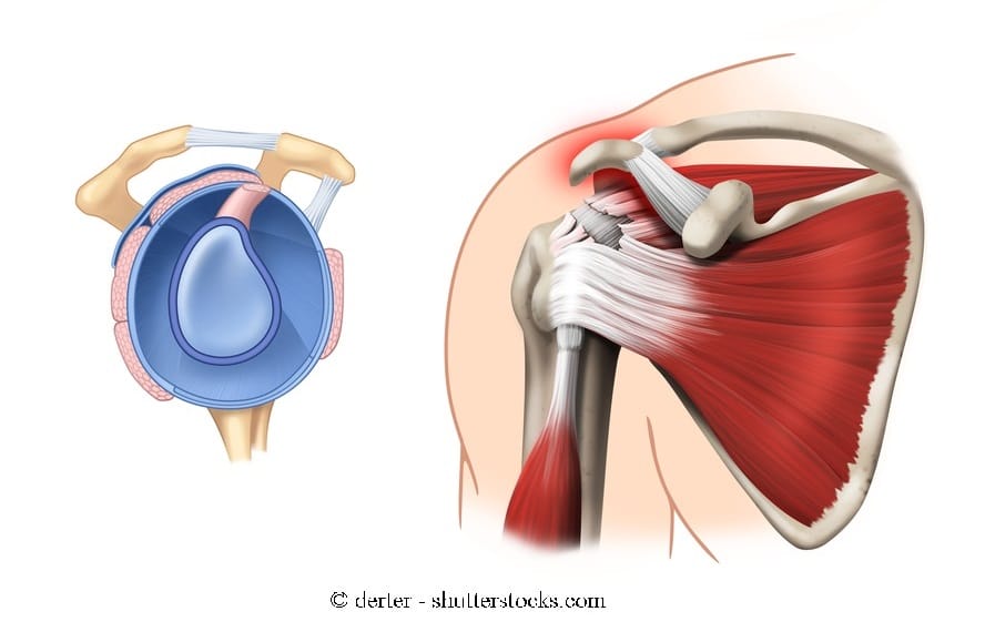 Разрыв надостного сухожилия плечевого сустава лечение