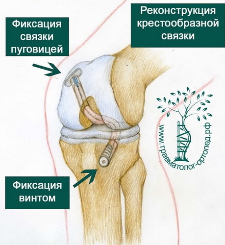 Фиксация это