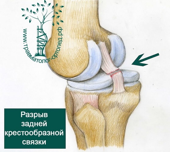 Разрыв крестообразной связки