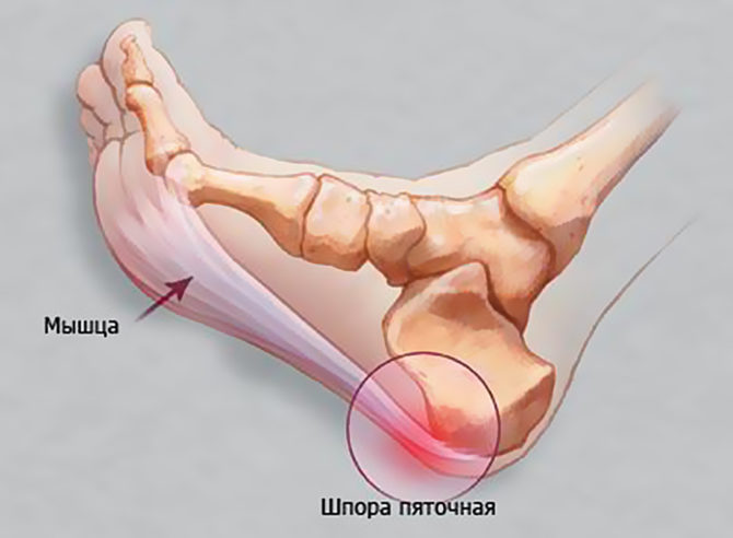 Бурсит при пяточной шпоре