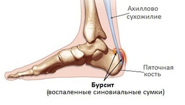 Пяточный бурсит - воспаление сумок