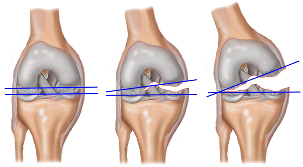 Три стадии разрыва связок колена