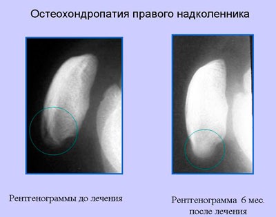 Снимки болезни Осгуда-Шлаттера до и после лечения