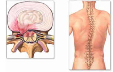 Межпозвонковая грыжа