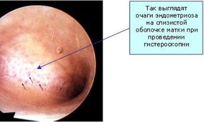 Что такое деформирующий спондилез